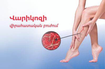Վարիկոզի բուժում Վարդանանցում՝ վիրահատական եղանակով