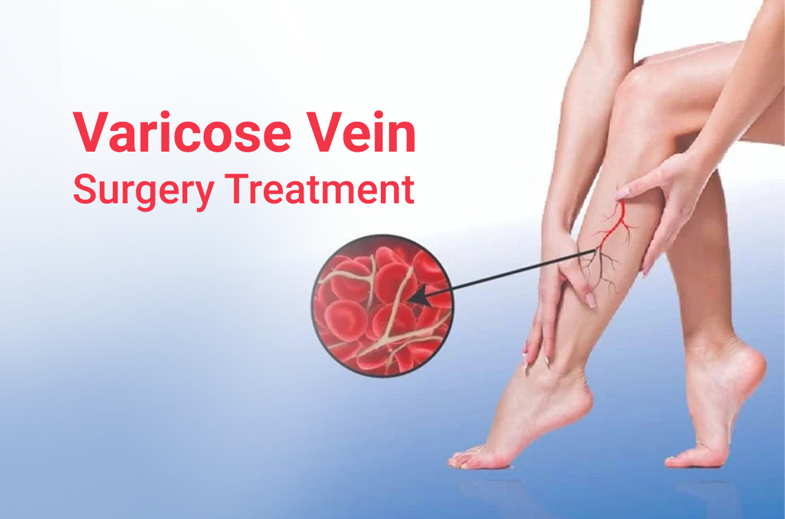 <p><strong>Varicose Vein Treatment at “Vardanants” — Surgical Method</strong></p>