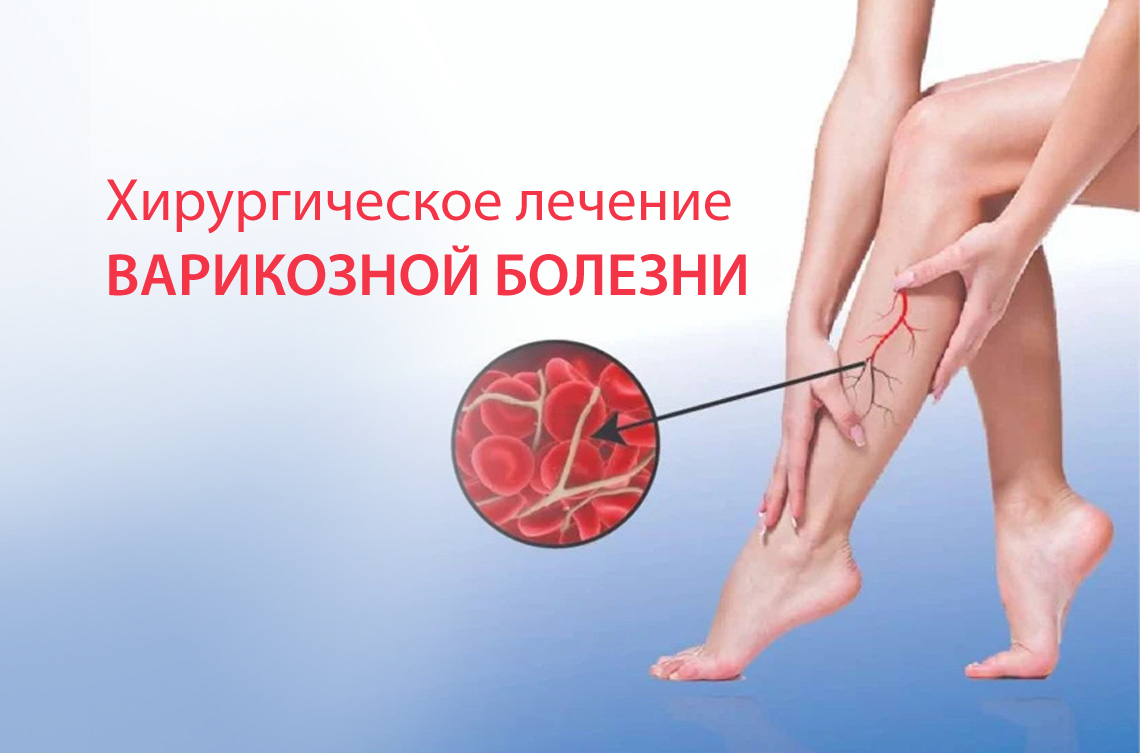 <p><strong>Лечение варикозной болезни в «Вардананц» — хирургическим методом</strong></p>