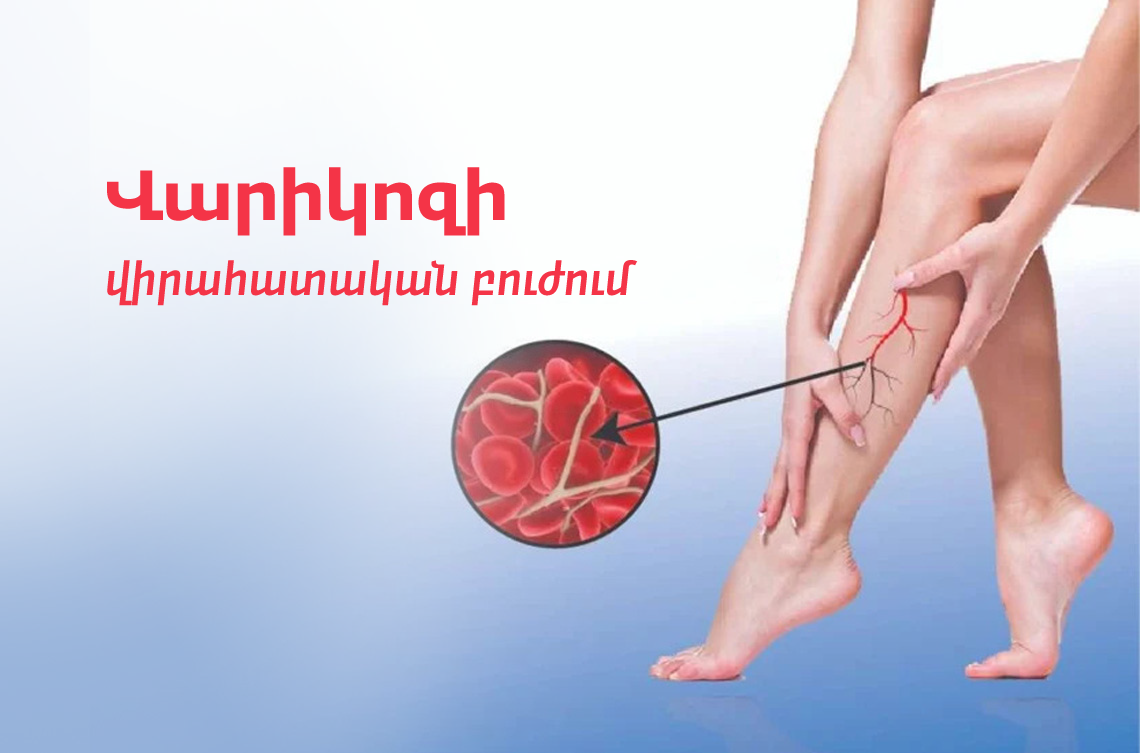 <p><strong>Վարիկոզի բուժում Վարդանանցում՝ վիրահատական եղանակով</strong></p>